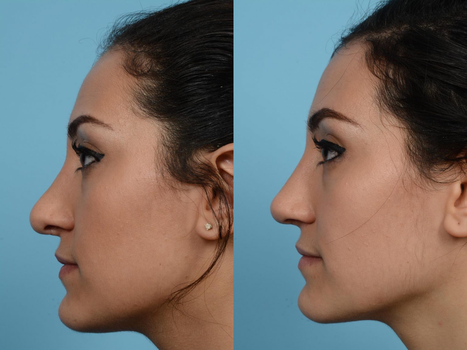 What I Do Differently For Revision Rhinoplasty TLKM Plastic Surgery