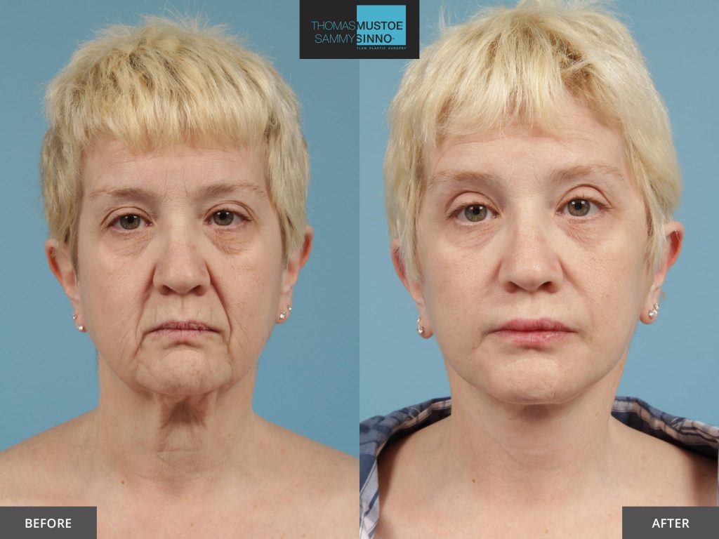 8 Facelift Before-and-After Photos That Prove Just How Natural