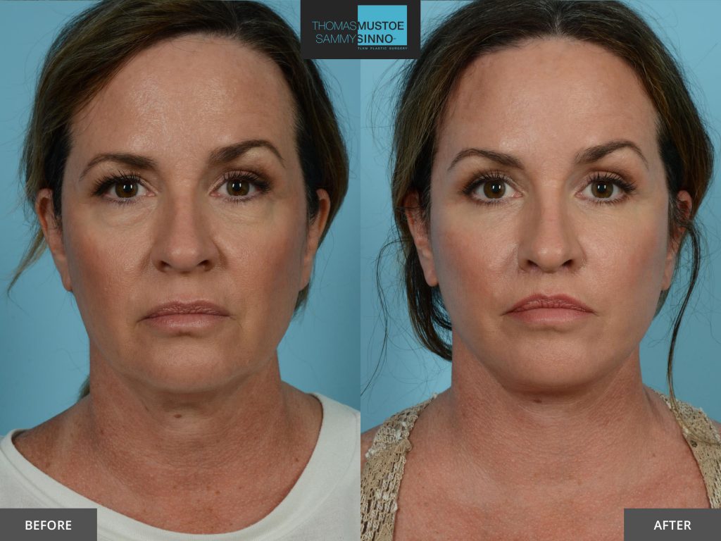 Face lift without surgery