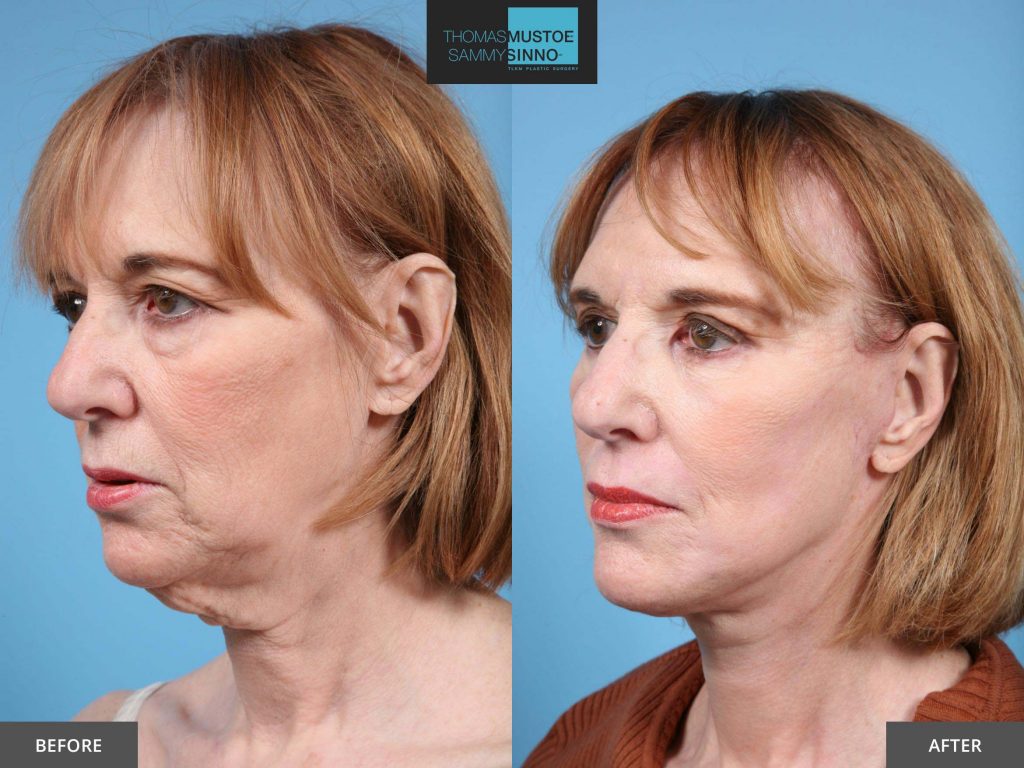 8 Facelift Before And After Photos That Prove Just How Natural Todays Results Look Tlkm 